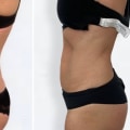 The Truth About Non-Surgical Liposuction Results