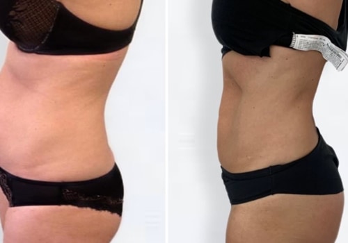 The Truth About Non-Surgical Liposuction Results